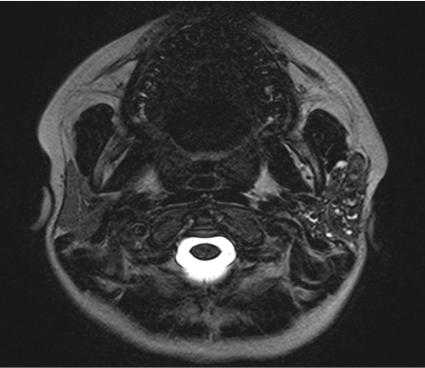 A 13 year old female with complaints of recurrent swelling with on and off pain in left cheek for 7 years, 5-6 episodes/year. Pain on chewing also present.