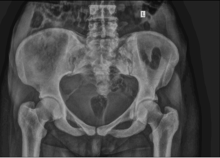 A 39 year old female presented with lower back pain and leg pain since 3 months.