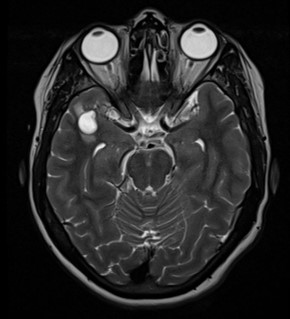 45 year old female presents with complaints of headache, giddiness and occasional vertigo for which MRI Brain was advised.