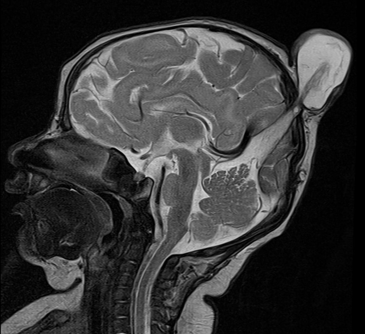 A 1-month-old male infant presented with complaints of midline swelling in the postero-superior region of head.