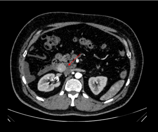 48 year old male Presented with history of 3 episodes of melena. No known comorbidities Gastro -Duodenoscopy - Erosive duodenitis Colonoscopy – unremarkable.