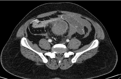 Patient presented in ER with history of not passing urine and stools since 1 day  Complains of abdominal discomfort and 5 episodes of vomiting. 
