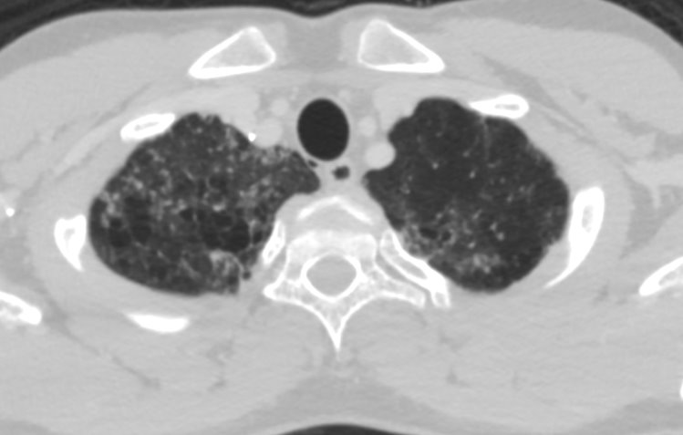 A 23 year old male presented with cough and dyspnoea since 3 months.