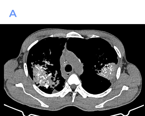A 37-year-old male presented with dyspnea on minimal exertion and recurrent cough since 2 weeks