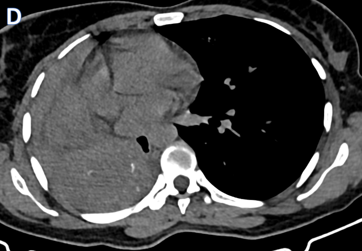 39 year old female patient presented with shortness of breath with history of persistent cough since 3 weeks and intermittent fever.  No weight loss.