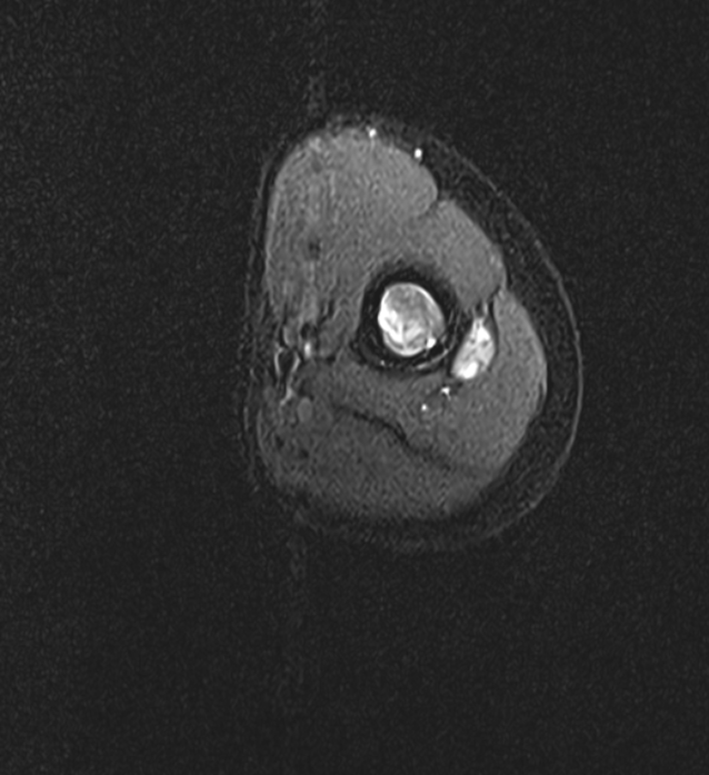 9 YEAR MALE CHILD, C/O- LEFT WRIST DROP, MILD SHARP PAIN OF HUMERUS DUE TO INJURY 8 MONTHS BACK, TO ASSESS FOR RADIAL NERVE INJURY