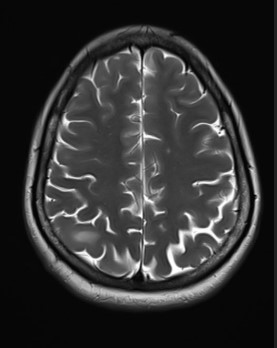 H/O SEIZURES.FIRST SEIZURES 15 YRS BACK.HEADACHE SINCE 15 DAYS.
