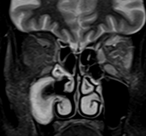 A 75 year old, with left 3rd and 6th nerve paresis. History of left herpes zoster.