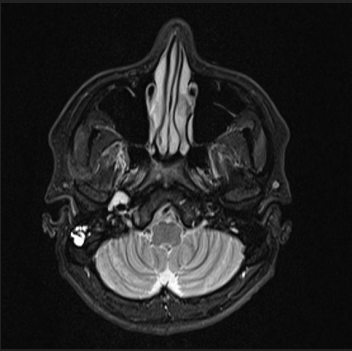 A 37-year-old male presents with progressive right sided hearing loss and a persistent sense of ear fullness for several months.
