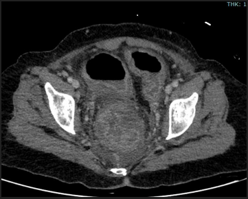 A 46 year old female with history of Urinary tract infection –MDR pseudomonas treated with antibiotics. Now presented with severe abdominal pain and vomiting.