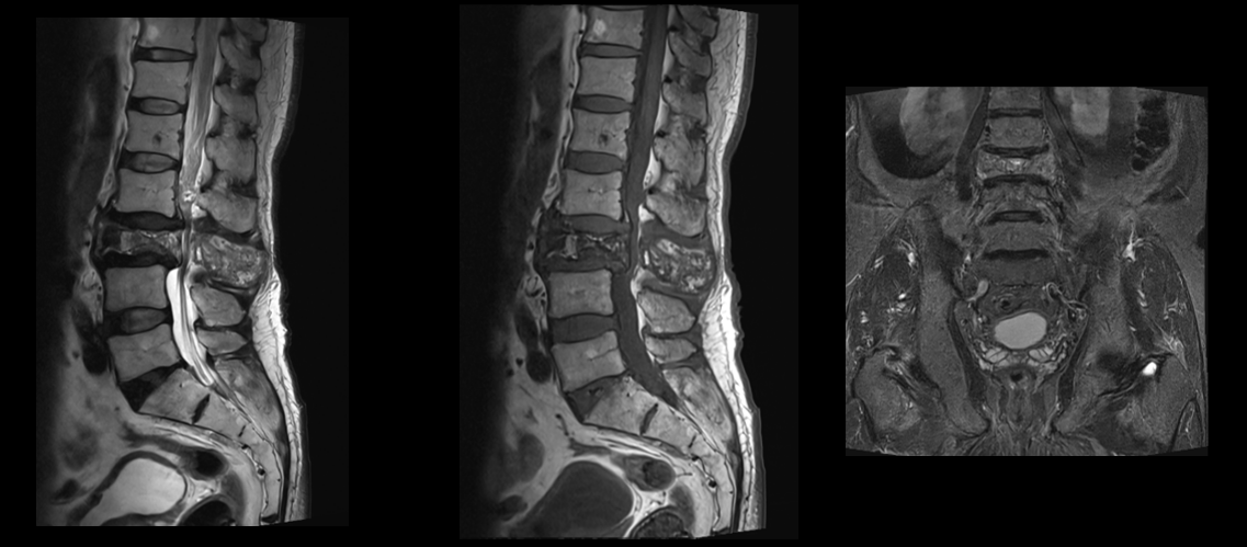 A 65 year old male,  Presents with low back ache with bilateral lower limb pain.